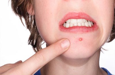 Ways to effectively get rid of acne in a child