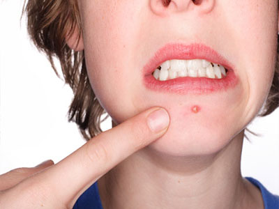 Ways to effectively get rid of acne in a child